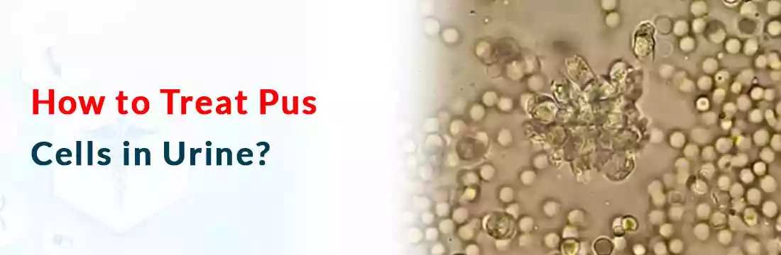  How to Treat Pus Cells in Urine?